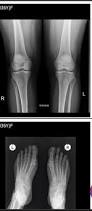 Image result for Knee XRay