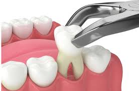 What to Eat After Tooth Extraction | Calgary