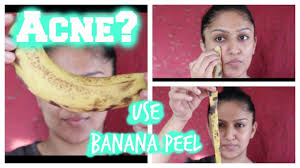Banana Peel Home Remedy For Acne Youtube You are soon going to bid goodbye to acne, once and for all! banana peel home remedy for acne