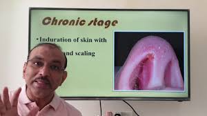 It can occur as acute or chronic type. Nasal Vestibulitis Malayalam Patient Teaching Programme Youtube