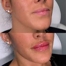 We love a little lip refresh! 💋 Holidays are coming- make sure you get  your appointments booked now! Remember healed results are the best results!  • • Few spots left before I