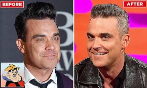 Robbie Williams admits cosmetic work