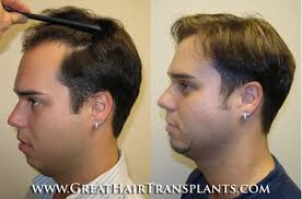 Best Rated Hair Transplant Doctor in Florida Hillsborough Jess Walden Oaks