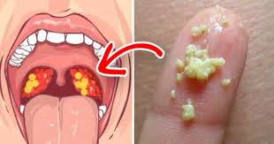 Ever Experience A Sore Throat But Think There Could Be More To It Than Having Strep Throat Or Tonsillitis Maybe Hemgjorda Ansiktsmasker Huskurer Ga Ner I Vikt