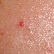 In many instances, an angioma will never need to be treated. Creating Flawless Skin