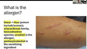 Image result for Rhus Dermatitis