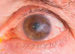 It begins with infection of epithelial cells on the surface of the eye and retrograde infection of nerves. Herpetic Keratitis Symptoms And Treatment Area Oftalmologica