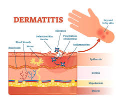 Image result for Atopic eczema atopic dermatitis