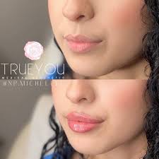 No filter needed ❌ She has beautifully shaped lips that just needed a  little enhancement for that natural-looking plumpness. Of course swelling  will reduce in a couple days. • • • Note: