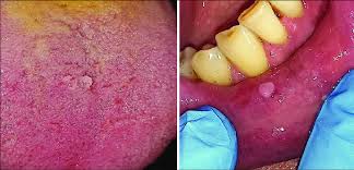 Image result for papillomavirus tongue)