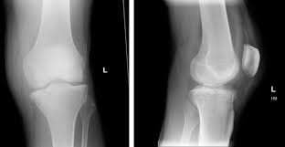 Image result for Knee XRay