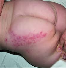 Image result for dermatitis contacta children