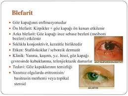 Goz Sismesi Goz Kapagi Sismesi Neden Olur Cok Iyi Abi
