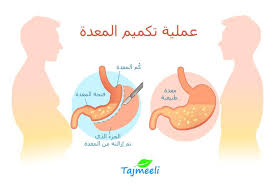 متى تلتئم المعدة بعد التكميم النصائح والعوامل تجميلي