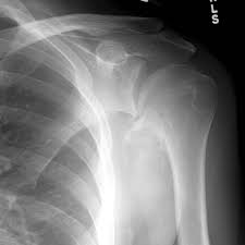 Image result for Chondrosarcoma