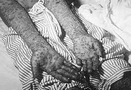 Cowpox served as a natural vaccine until the modern smallpox vaccine emerged in the 20th century. Vaiolo Le Caratteristiche Dell Infezione Virale