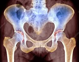 Image result for Hip XRay