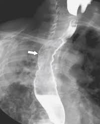 Epidemiology the actual incidence and prevalence of idiopathic esophagitis of hiv are unknown. Esophagus Clinical Gate