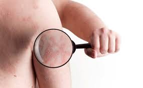 They think it takes more than one to cause the disease, and they're looking for the main ones. Psoriasis Causes Symptoms And Triggers