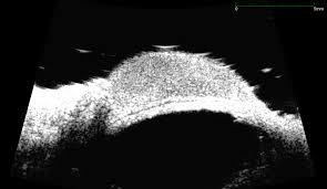 Image result for conjunctival melanoma
