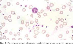 Prca arises when damage occurs to the bone marrow, where it is unable to produce a sufficient amount of red blood cells. Pdf Carbamazepine Induced Pure Red Cell Aplasia Semantic Scholar