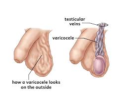 Image result for Varicocele