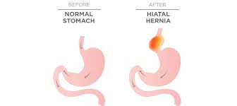 How To Fix A Hiatal Hernia Naturally Healthy Directions
