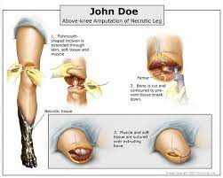 Above Knee Amputation Of Necrotic Leg Medical Illustration Medical Vascular Surgery