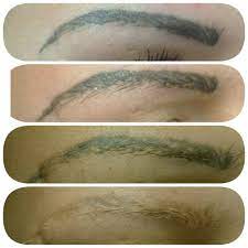 How to remove eyebrow tattoo at home?, how to erase eyebrow tattoo? and can eyebrow tattoo be corrected? were just some commonly searched questions i found while researching this story. Tattoo Eyebrow Removal Before And After Lorena Oberg