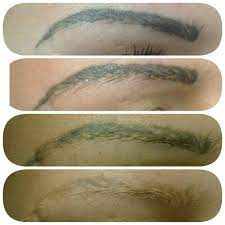 It is gentle on the skin. Tattoo Eyebrow Removal Before And After Lorena Oberg