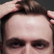 | receding hairline women, hairstyle for kids, hairstyle for girls, hairstyle for kids girl, hairstyle for boys, hairstyle for men, hairstyle for black scalp tattoo micropigmentation treatment explained via. This Guy Just Shared 5 Tips For Hiding A Receding Hairline