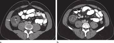 Image result for Neutropenic Colitis