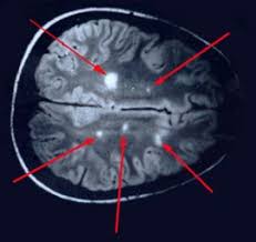 Schandalige Cover Up Multiple Sclerosis Is Lyme Disease Anatomy Of A Cover Up Nieuwsbreker
