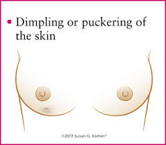 The american cancer society warns that skin dimpling on the breast can be a sign of cancer, though many women may be unaware of its significance. Dimpling Breast Cancer Awareness Hub