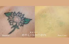 We estimate three to five sessions to fade for a cover up piece and ten to twelve sessions for full removal based on tattoo colors and sizing. Laser Tattoo Removal Arkansas Laser And Skin Care