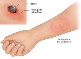 Zecken beißen nicht, sondern stechen. Borreliose Gesundheitsinformation De