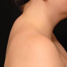 A neck hump is also known as a buffalo hump or a dowager's hump. Start Feeling Better By Getting Rid Of Your Buffalo Hump Pure Posture