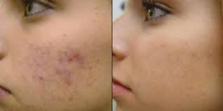 Mikrodermabrasion tuch erase falten narben anti aging akne behandlung peeling. Mikrodermabrasion Gerat Test Juli 2021 Top 4 Modelle