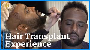 The best hair transplant and hair restoration at the lowest possible price. Hair Transplant Experience Afro American Guest From Los Angeles Youtube