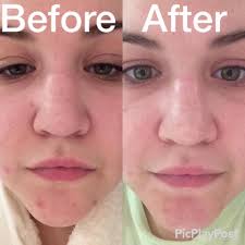 🧖🏽‍♀️🪄 The Versatile Hydradermabrasion Treatment ✨️Comprehensive  Approach✨️ 🌟Combines the benefits of hydradermabrasion, a chemical peel,  painless extractions, and a delivery of antioxidants, hyaluronic acid, and  peptides ...