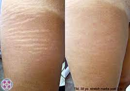 I get asked about stretch marks at least. Rf Microneedling Stretch Mark Reduction Services Executive Skin Laser Palm Harbor