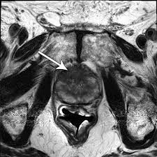 Ng fat kim (mn ng jok ming). Multiparametric Mr Imaging Of The Prostate After Treatment Of Prostate Cancer Radiographics