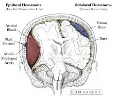 Charcot Bouchard Subdural Hematoma Epidural Hematoma Icu Nursing