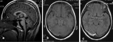Handbook of clinical neurology, 2014. Cerebral Venous Sinus Thrombosis Review Of The Demographics Pathophysiology Current Diagnosis And Treatment In Neurosurgical Focus Volume 27 Issue 5 2009