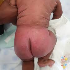 Image result for dermatitis contacta children
