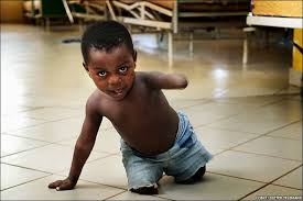BBC News - In pictures: Disabled Tanzanian child taking first steps
