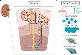 Image result for Calcium Nephrolithiasis