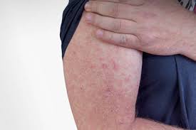 Image result for erysipel photos)