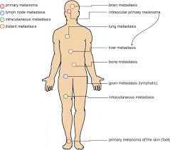 Es entsteht meist nach längerer zeit auf dem boden einer lentigo maligna. Challenging The Heterogeneity Of Disease Presentation In Malignant Melanoma Impact On Patient Treatment Springerlink