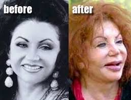 The number of people getting cosmetic procedures has risen steadily over the past five years and there are several reasons why. Celebrity Before And After Plastic Surgery Disasters Mbf